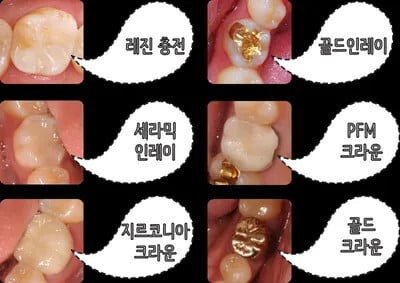 라이나 치아보험 레진 크라운 보장 정리 (+2025 최신 가입조건, 보장금액, 주의사항) 1 레진-크라운-비교