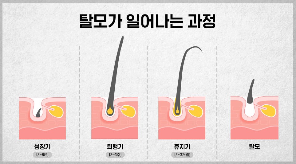 탈모-발생-과정