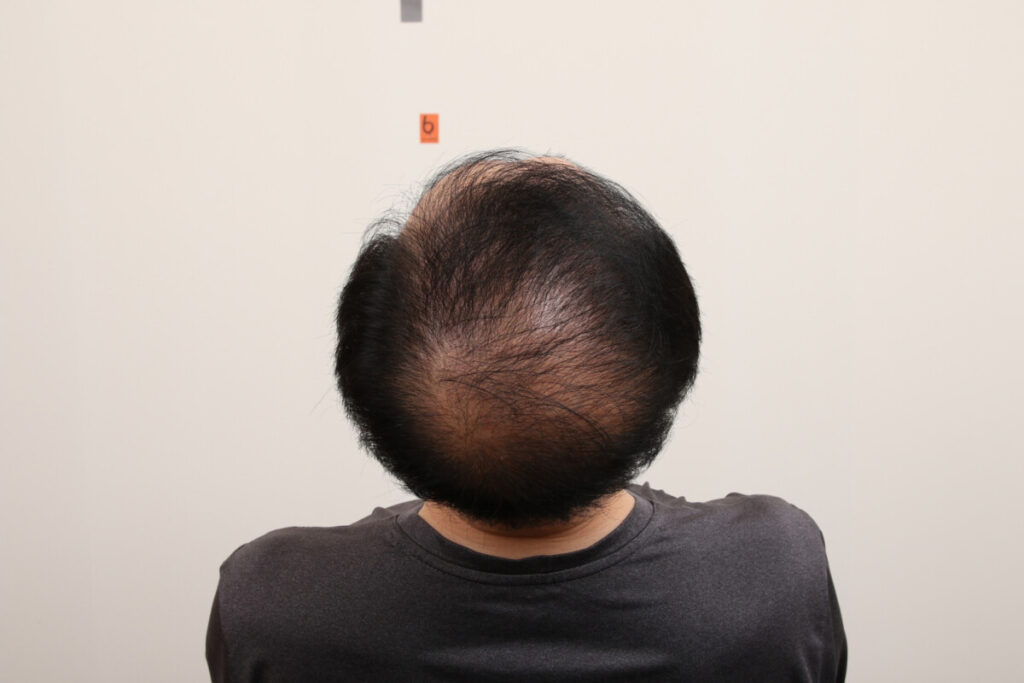 부산 탈모 성지 완전 정복|망미동 장산 서면 금정구 사상까지 (꼭 알아야 할 꿀팁!) 1 부산-탈모